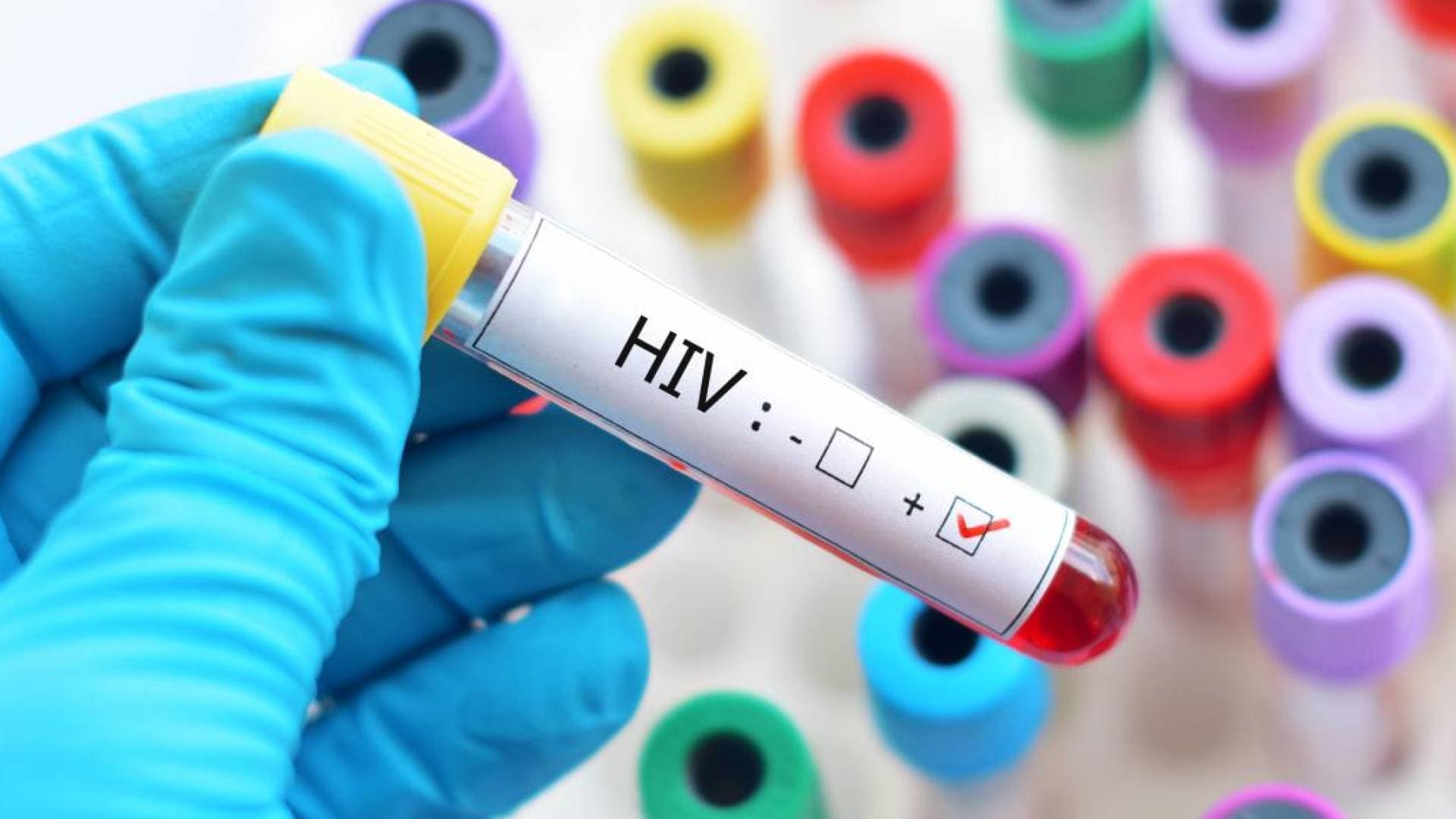 ما هي أعراض الإيدز وبماذا تختلف عن فيروس نقص المناعة البشرية؟