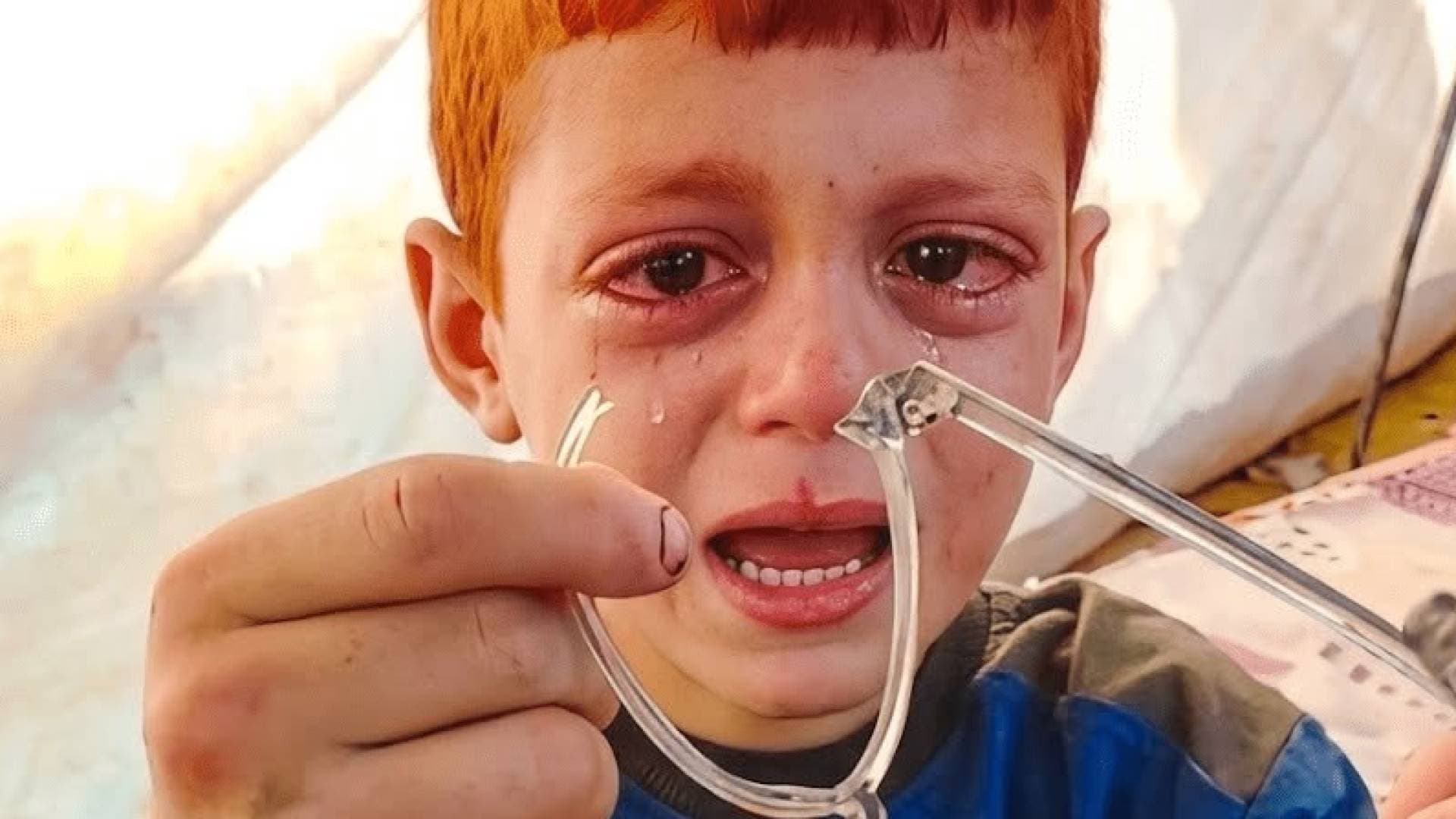 بدعم من وكالة الإمارات للمساعدات الدولية .. طواقم عملية "الفارس الشهم 3" تلبي نداء الطفل "أيوب " وتوفر له الرعاية الطبية التي يحتاجها