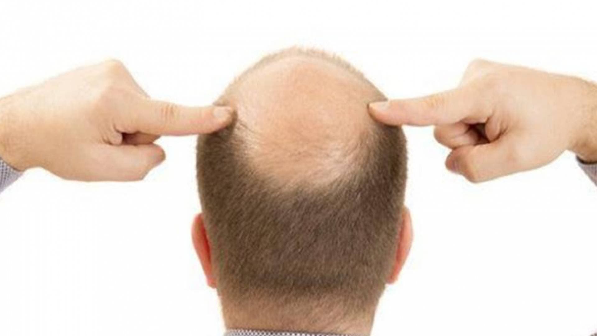دراسة تمهد الطريق لعلاج الصلع