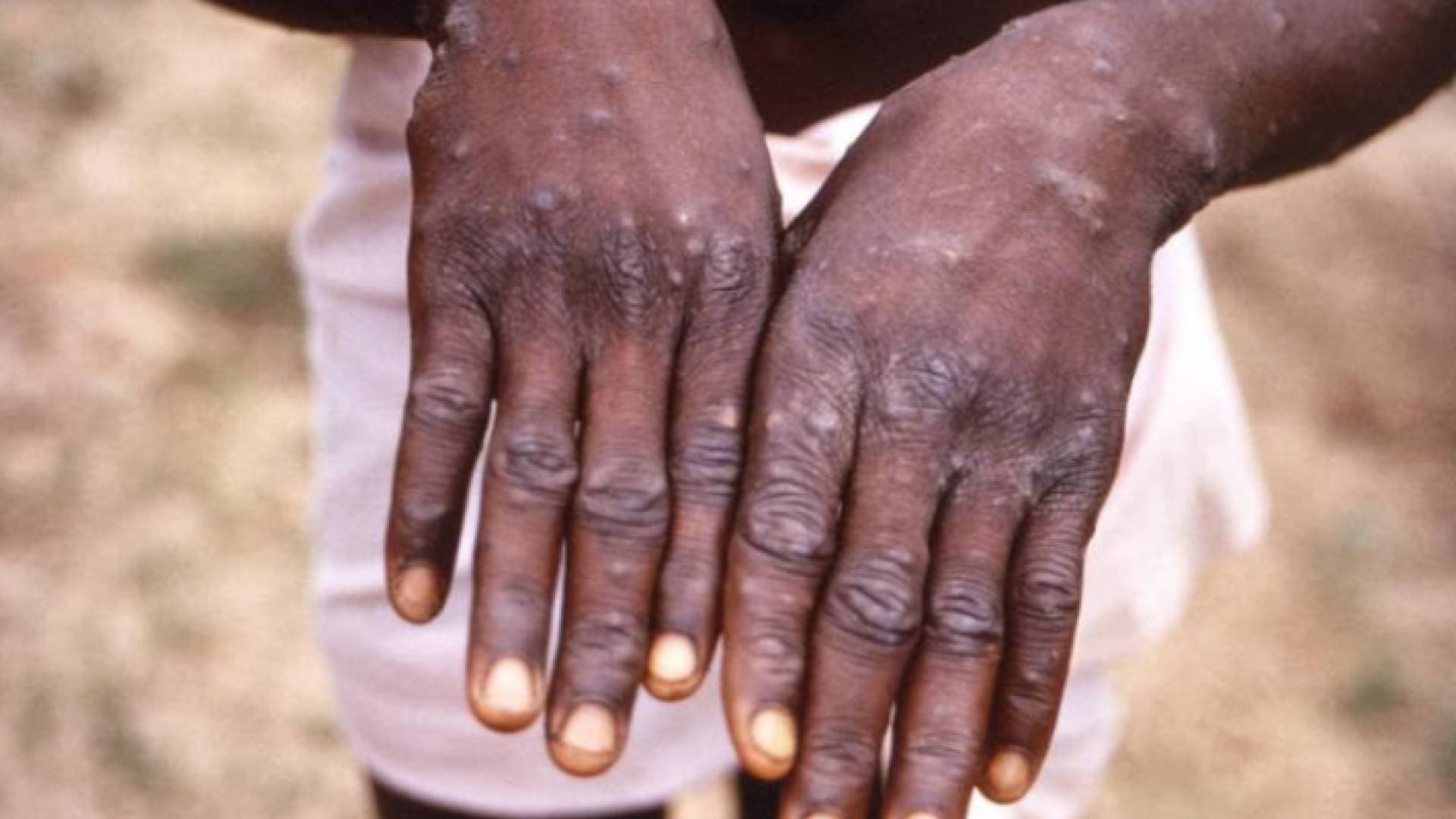 النمسا تسجل أول حالة يشتبه بإصابتها بجدري القردة