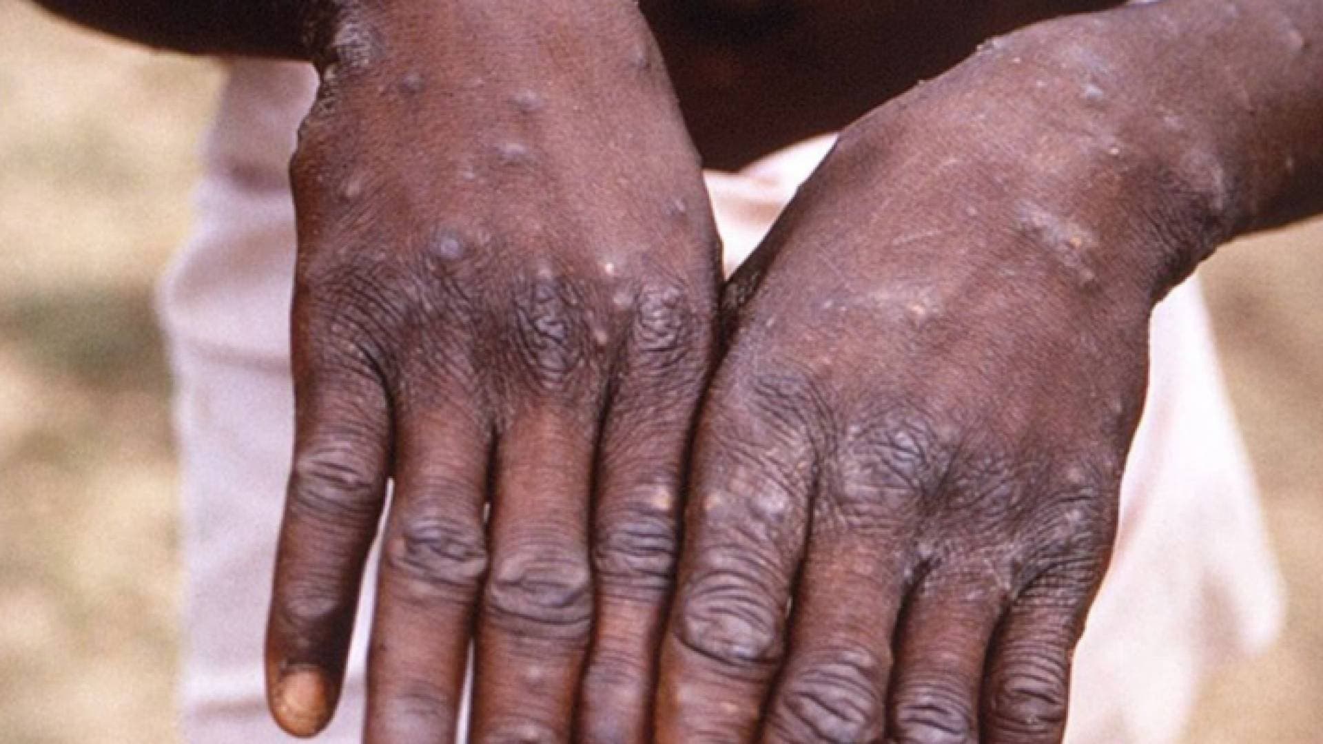 نيجيريا تعلن تسجيل ٢١ إصابة بجدري القرود
