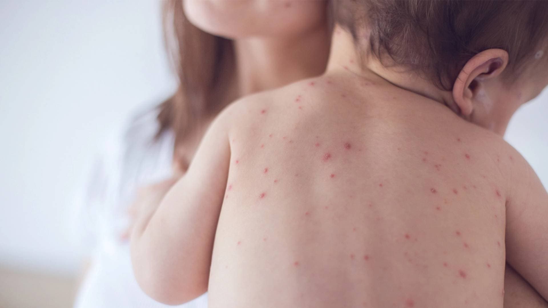 تفش واسع.. 3 وفيات وأكثر من 700 إصابة بالحصبة في الولايات المتحدة