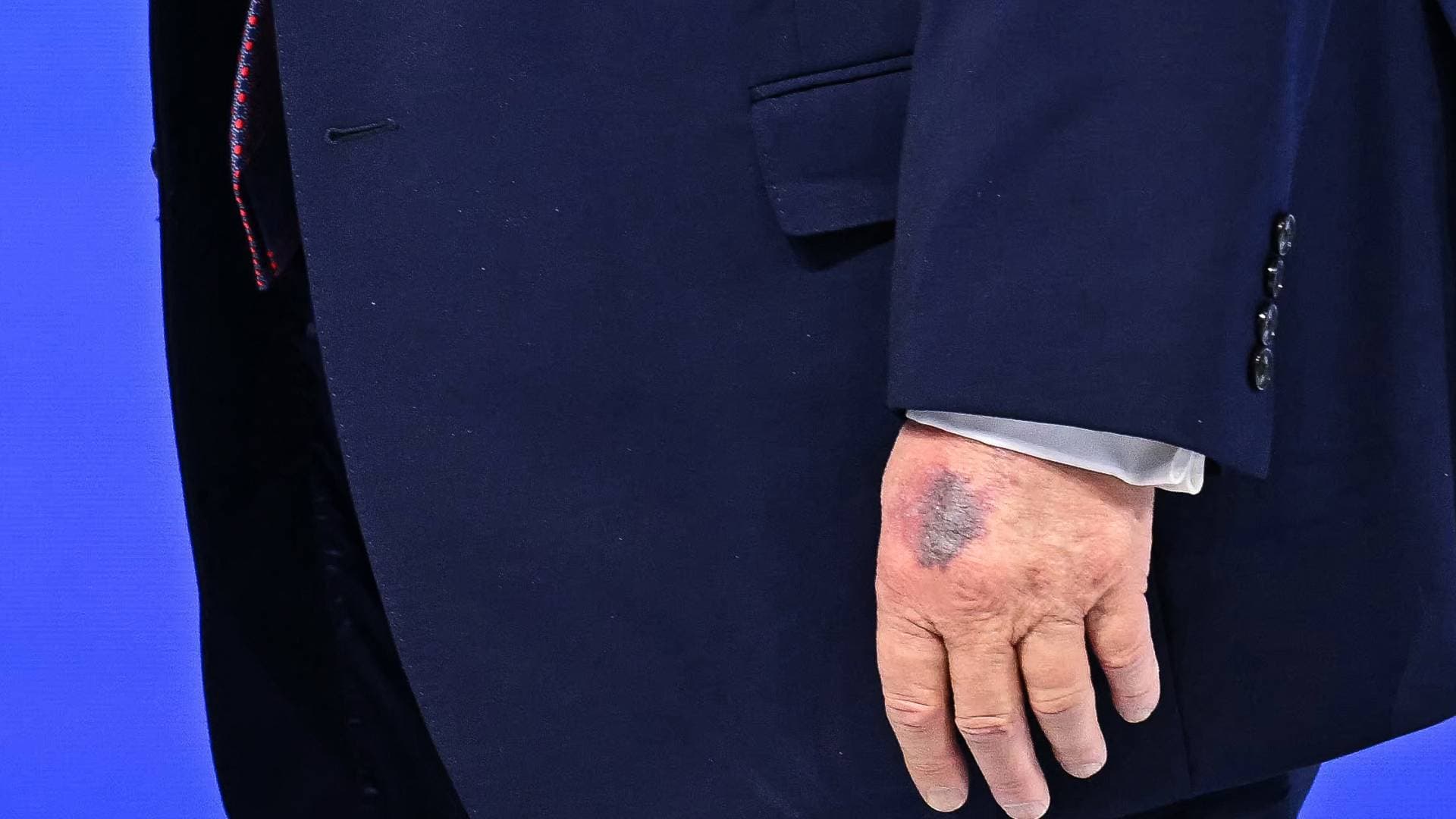 ترمب يكشف سر "الكدمة الزرقاء" على يده في دافوس